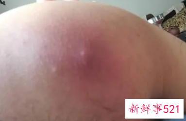 屁股上长硬疙瘩特别疼