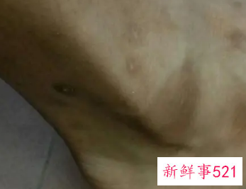 去除摔伤黑印的偏方