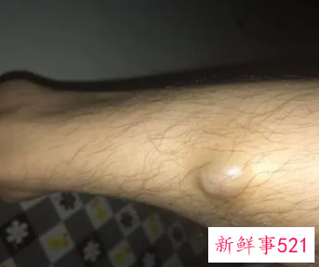 腿上肿了个包发红硬疼