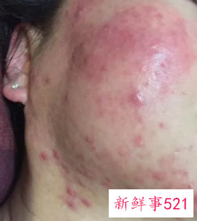 敏感性皮肤长痘痘