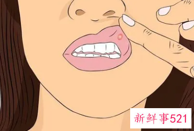 口腔溃疡怎么办怎么快速消除