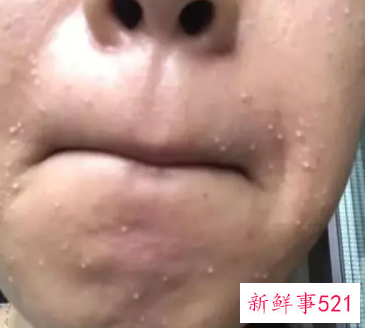 敏感性皮肤长痘痘