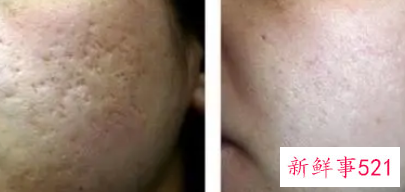 激光治疗毛孔粗大需要多少次美容