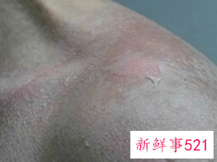 皮肤晒伤了应该怎么处理比较好