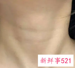 怎样可以改善颈纹