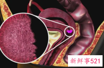 梦见做了子宫手术寓意