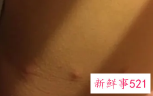 屁股上长硬疙瘩特别疼