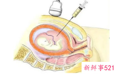 做羊水穿刺疼吗