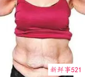 肚皮松弛下垂怎么办