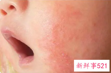 宝宝湿疹怎么处理