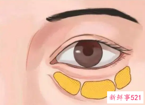 怎么治好眼袋呢