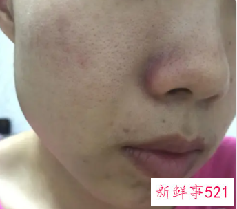 脸颊长痘痘是哪里的问题