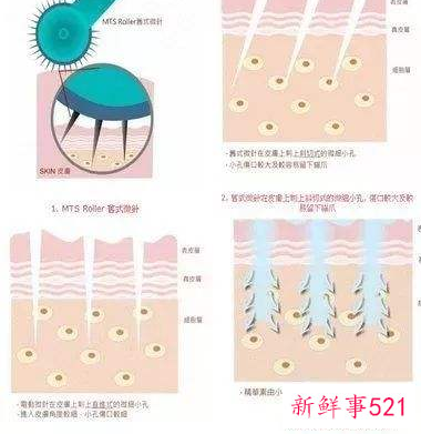 超嫩肤光子的功效与作用
