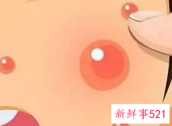 秋天皮肤干燥长痘