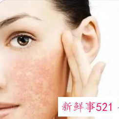 皮肤屏障受损如何治疗