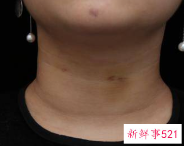 女子颈纹太深说明什么