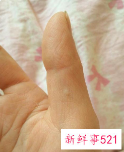 手指上有凸起的小疙瘩