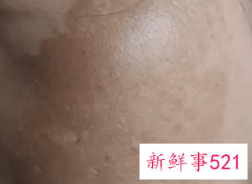 如何能去掉蝴蝶斑