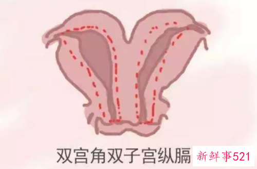 子宫纵隔为什么怀孕难