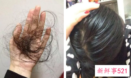 头发太油脱发怎么解决