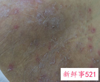 手臂上有米粒白色凸起痒