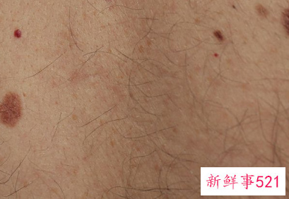 风油精可以杀螨虫