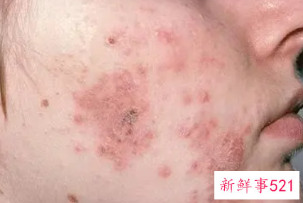 螨虫和痘痘的区别