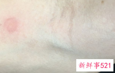 手臂上有米粒白色凸起痒