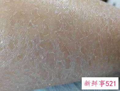 孕早期皮肤干燥脱皮