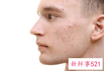 怎样改善面部毛孔粗大