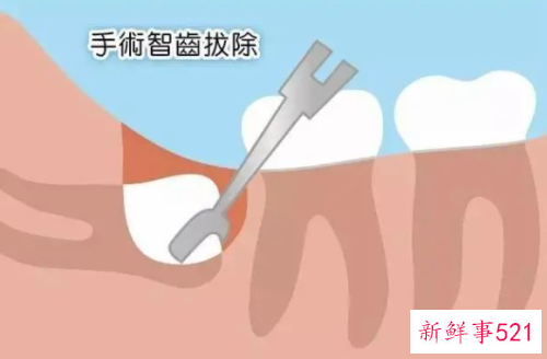 长智齿一定要拔掉的四种情况