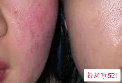 去除红血丝修复角质层