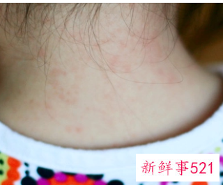 幼儿急疹的好处与坏处