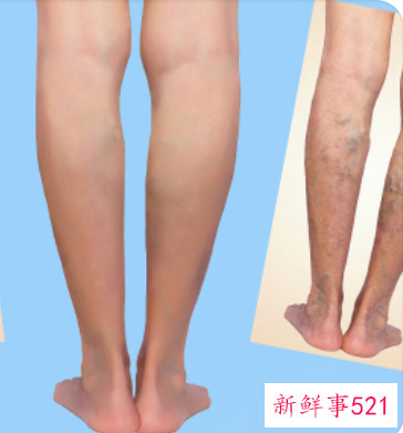 怎么有效改善小腿外翻