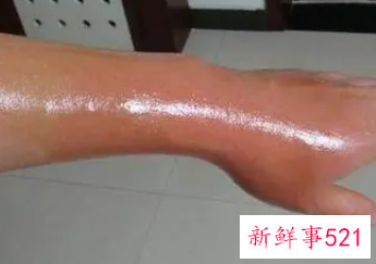 烫伤后一直灼疼咋办