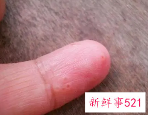 手指上面长了个小疙瘩透明凸起痒