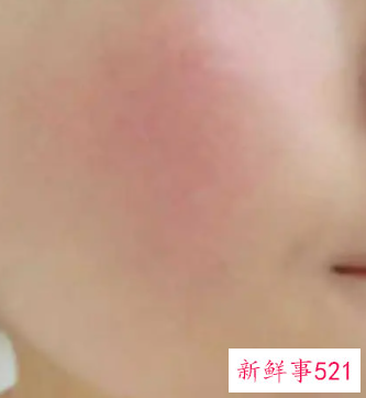 皮肤角质层特别薄怎么办