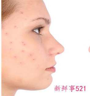 脸上长痘对应五脏示意图