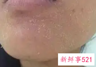 敏感干燥脱皮好久了怎么办