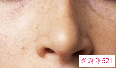 怎么去掉脸上的黑斑黑色素