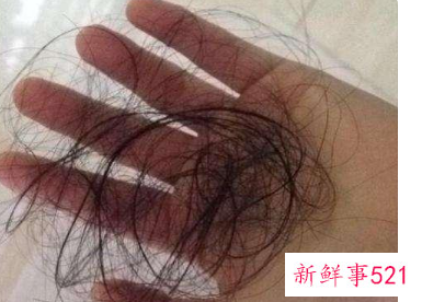女生掉头发怎么办
