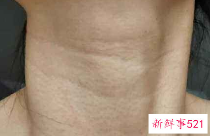 颈纹怎么消除效果好