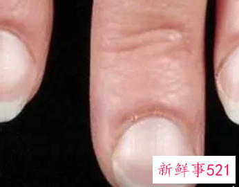 指甲宽扁有什么办法改善
