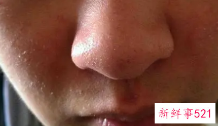 如何改善全身皮肤干燥起皮