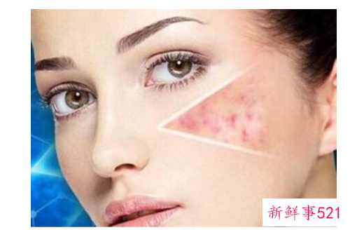 怎么加速黑色痘印淡化