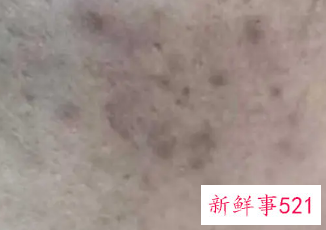 黑色素自己慢慢的会淡化