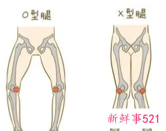 婴儿用纸尿裤会不会影响腿型