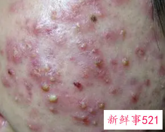 如何解决脸上的痘痘