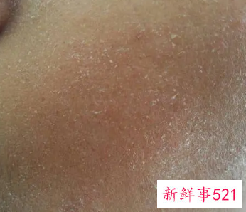 脸上总是出现白色的死皮