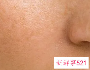 黑色素自己慢慢的会淡化